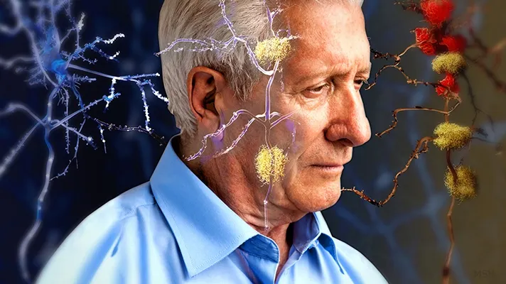 Bacteria asociată cu infecțiile respiratorii ar putea avea legătură cu boala Alzheimer, sugerează un studiu