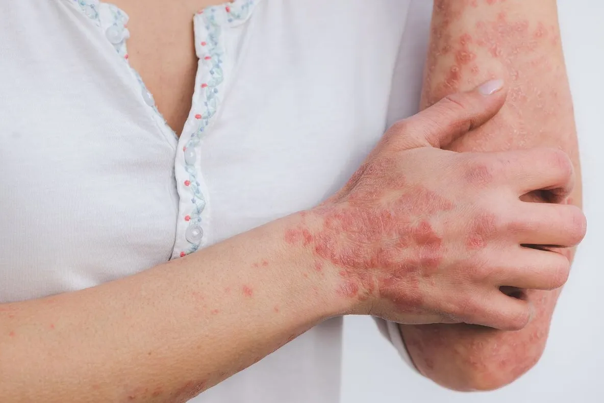 Psoriazisul pustular: care este particularitatea sa și cum să-l tratezi?
