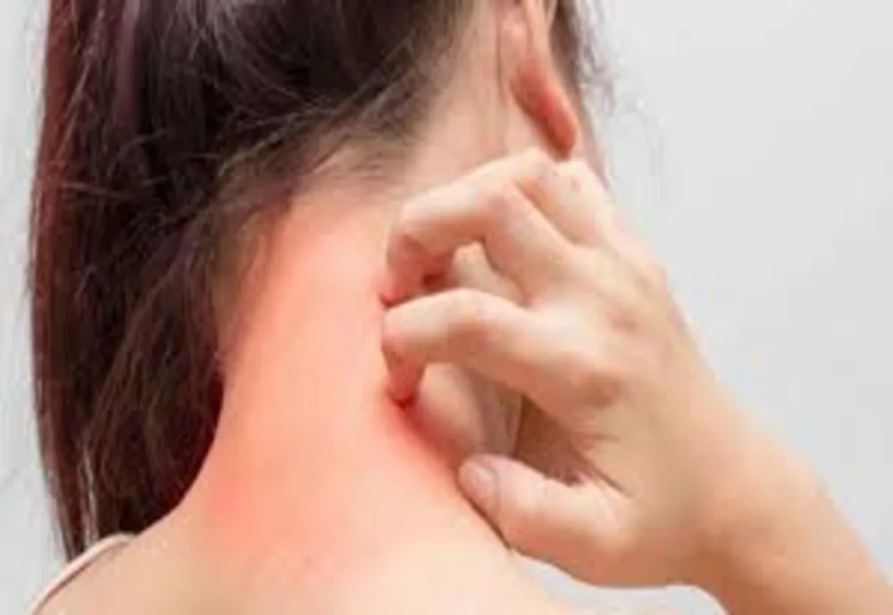 Alergia la latex