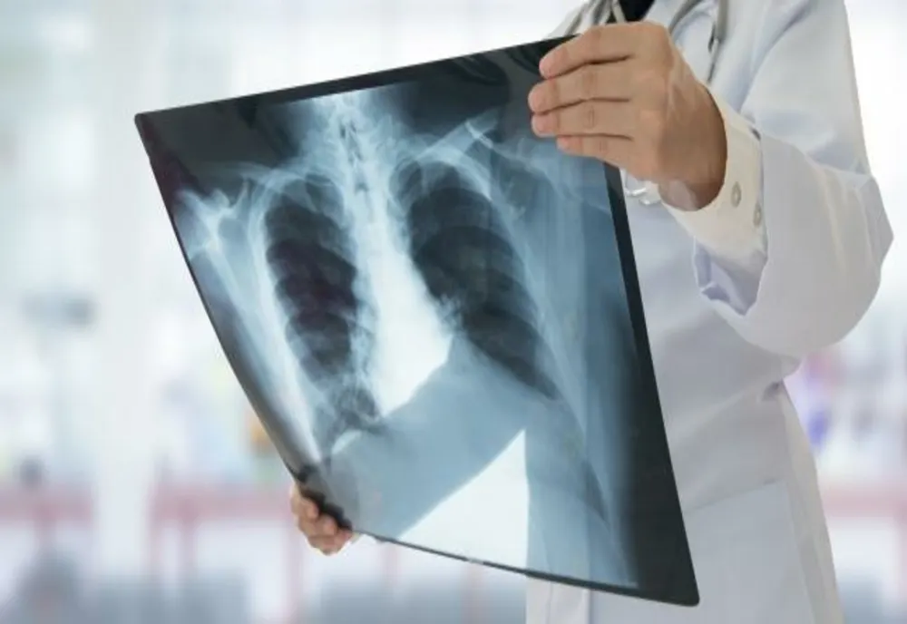 Alertă epidemiologică: Focar de tuberculoză la o grădiniţă din Iași