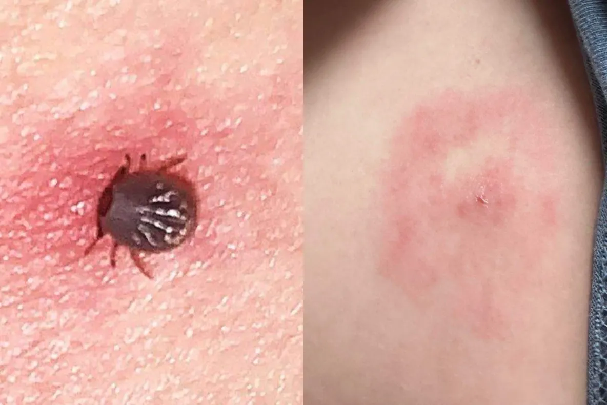 Cum arată căpușa „Lone Star”? Mușcătura care poate declanșa o alergie neașteptată la carnea roșie