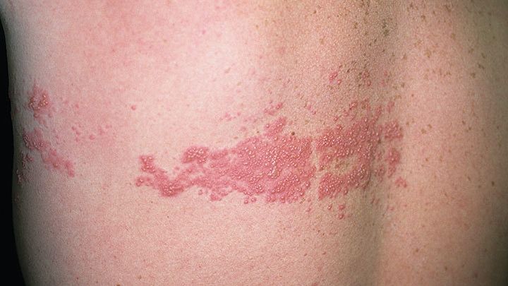Zona Zoster: cauze, simptome și metode de prevenție