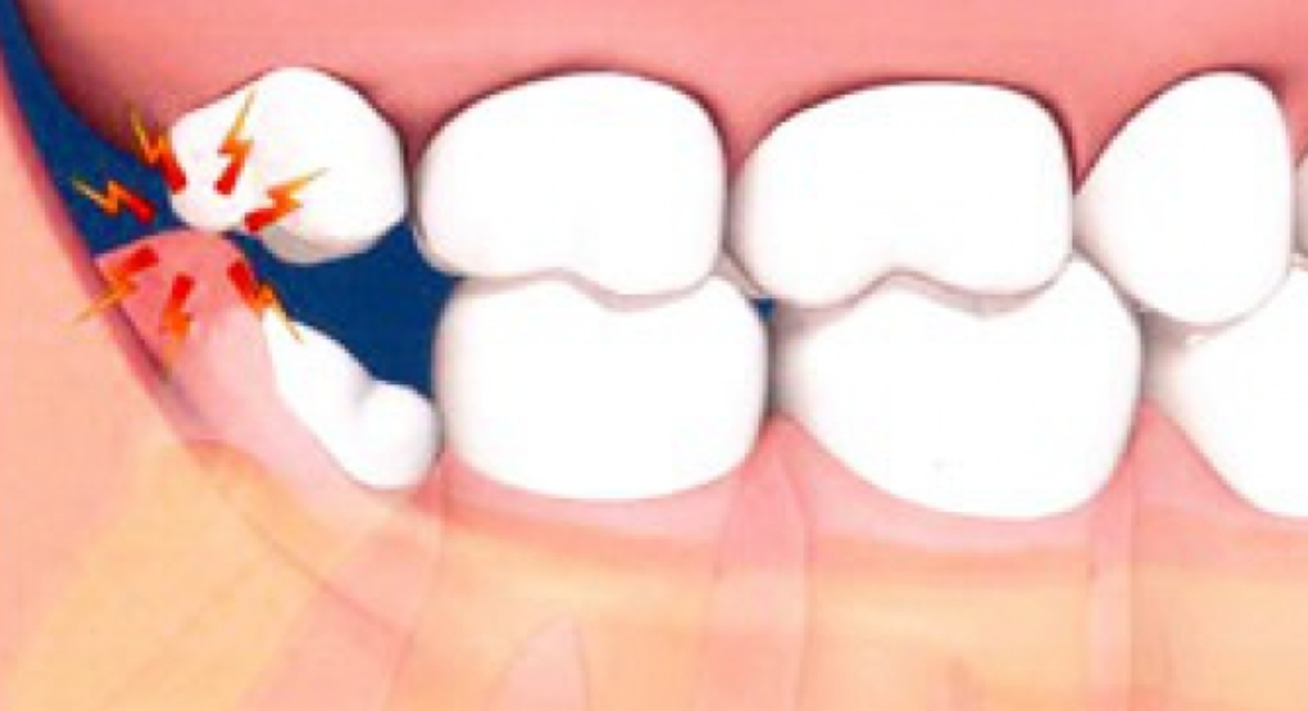 Problemele cauzate de molarul de minte inclus