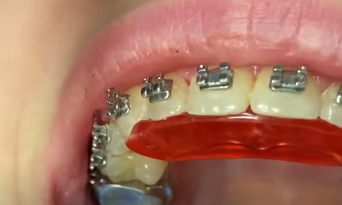 La ce vârstă trebuie purtat un aparat dentar mobil?