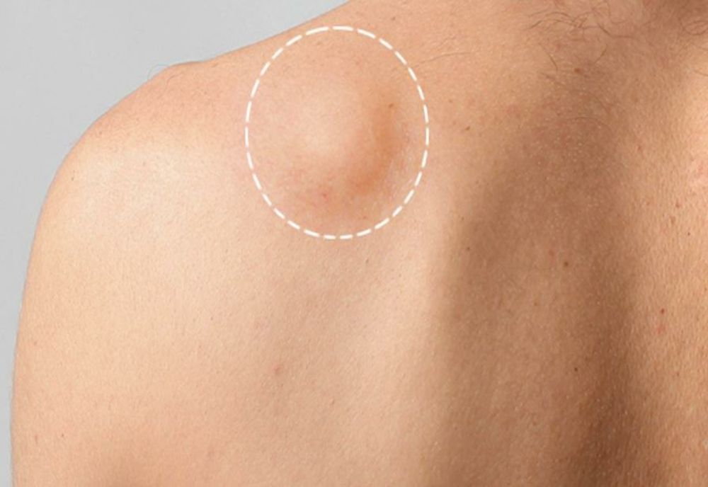 Lipomul: Cauze, manifestari si optiuni de tratament