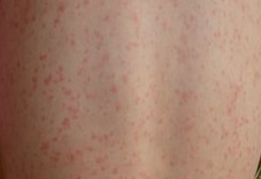 Scarlatina: o boală a copilăriei