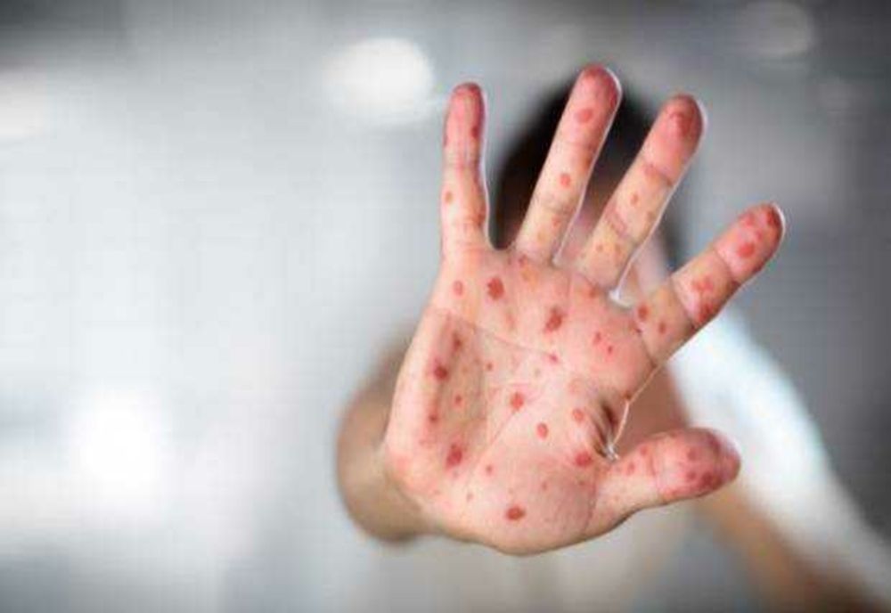 Rujeola revine la nivel global, avertizează OMS 
