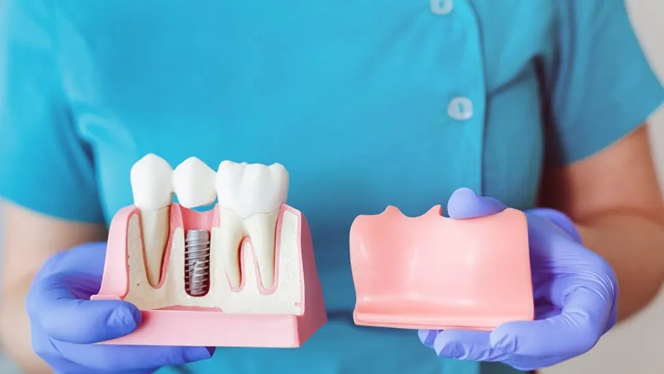 Implantul dentar: ce se întâmplă, pas cu pas