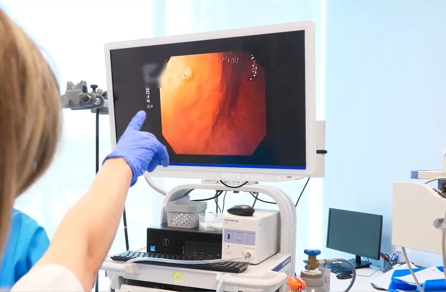 Rolul colonoscopiei in diagnosticul și prevenția cancerului de colon
