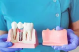 Implantul dentar: ce se întâmplă, pas cu pas