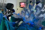 Tratamentul chirurgical al cancerului de prostată: Prostatectomia robotică