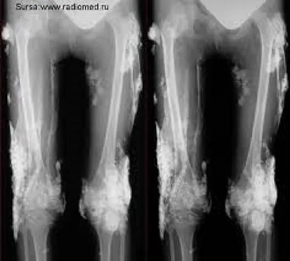 calcifierea