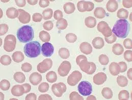 leucemia_limfocitara_cronica