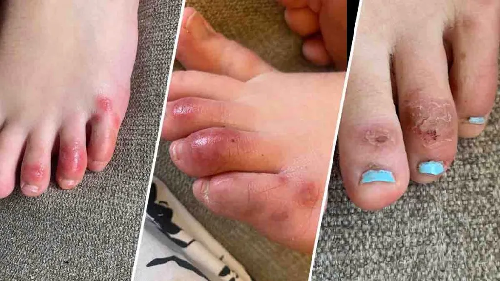 covid_toes