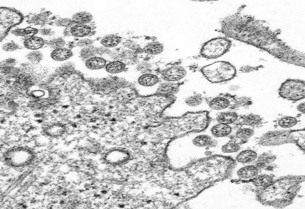 Cercetătorii americani au descoperit o mutație care sporeşte capacitatea de infecţie a virusului SARS-CoV-2