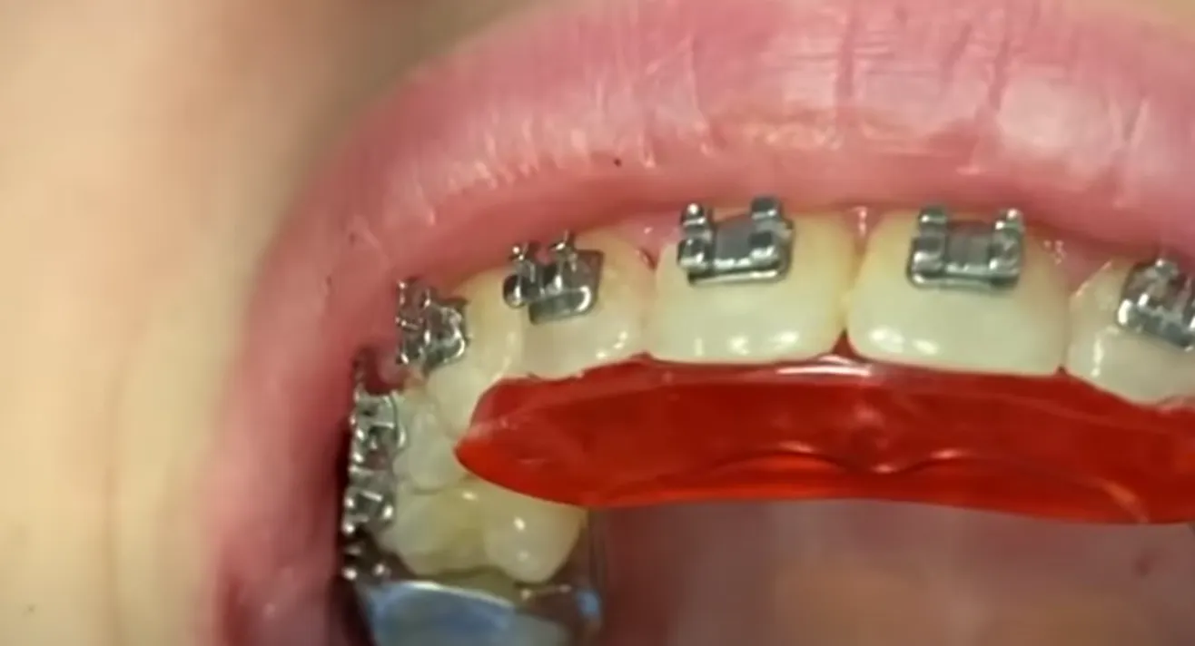 aparat_dentar_mobil