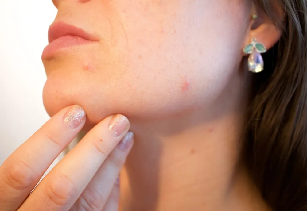 ACNEEA: Când mergem la medic?