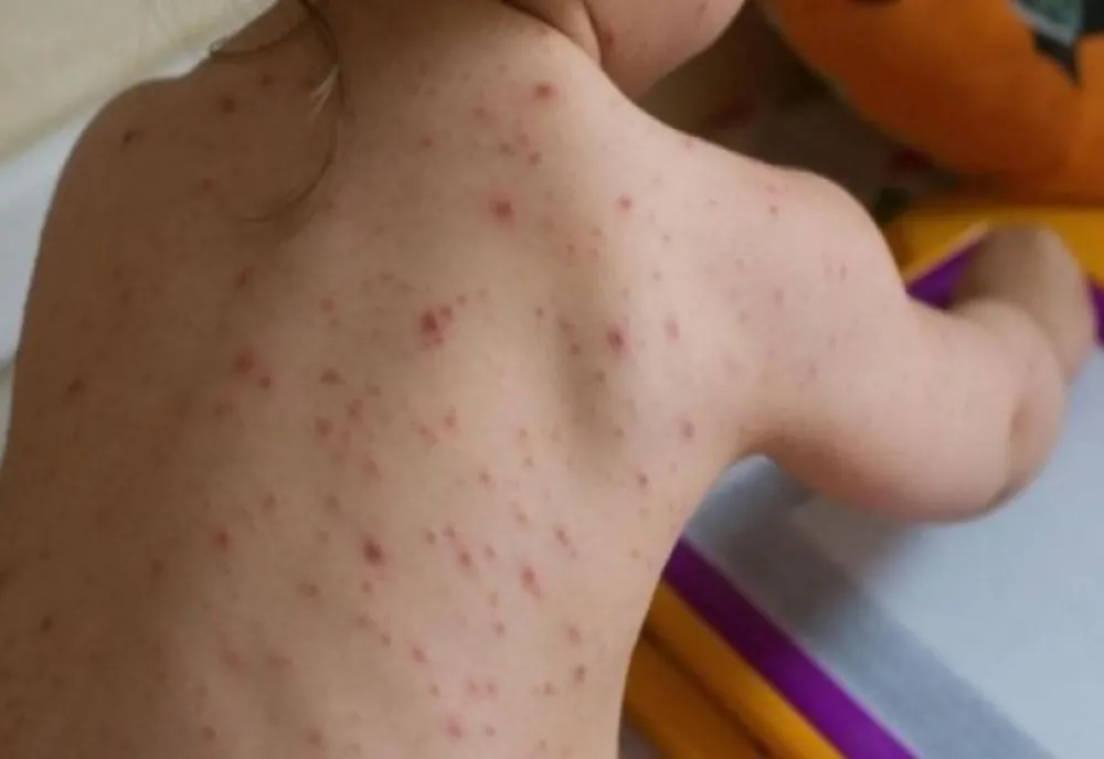 INSP: Peste 650 de cazuri noi de rujeolă înregistrate în ultima săptămână
