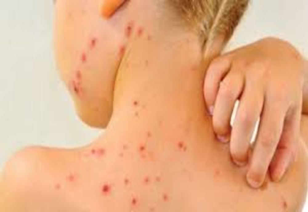 În plină epidemie de coronavirus, rujeola contină și ea să facă victime