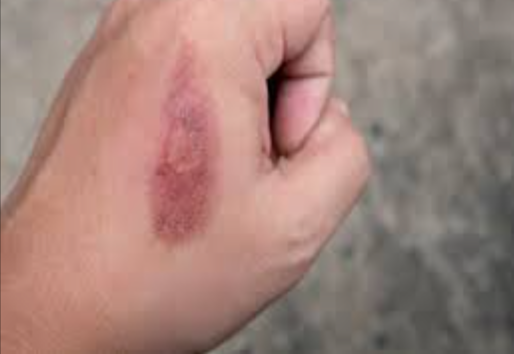 Primul ajutor în cazul arsurilor