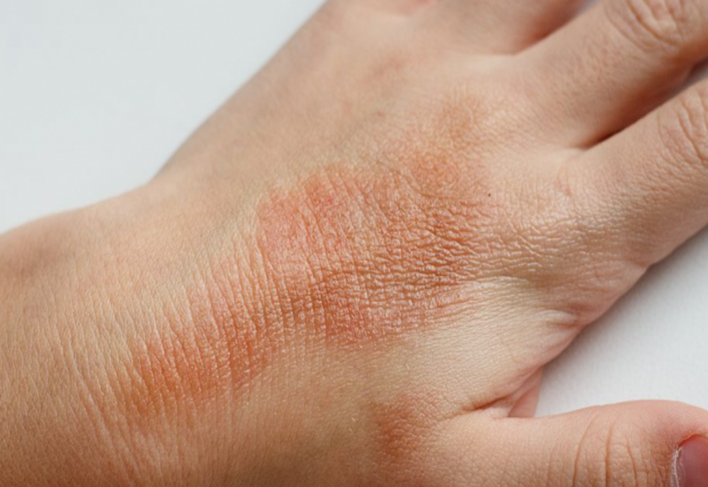 Eczema: Cauze, simptome, tratament