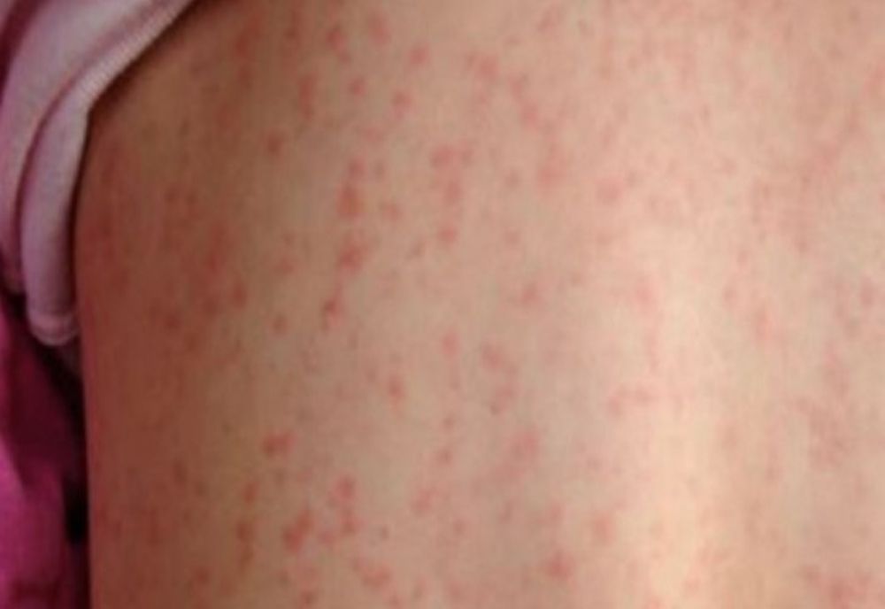 Semnal de alarmă al OMS: Cazurile de rujeolă la nivel mondial au crescut cu 18%