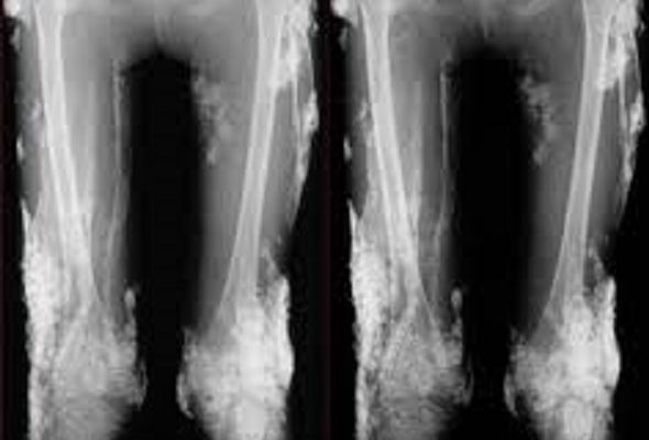 Tot ce trebuie să știi despre calcifiere