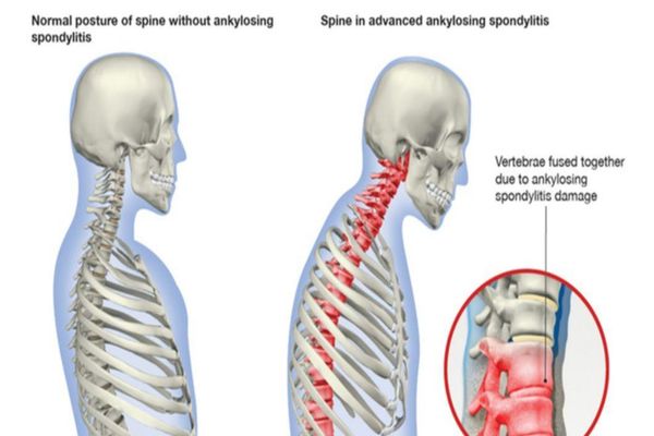 Spondilita anchilozantă