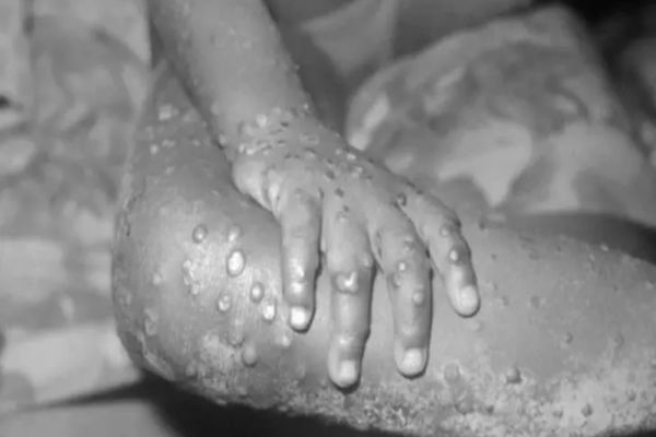 A fost diagnosticat PRIMUL caz de variola maimuței la copil: Un băiețel mai mic de 10 ani