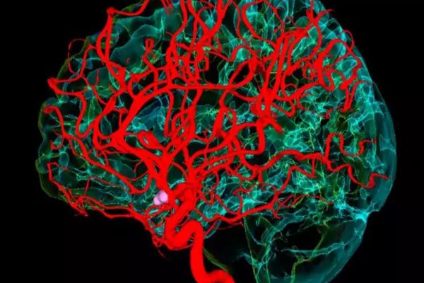 Accident Vascular Cerebral. Cum te recuperezi după un AVC. Ce simptome post-AVC poți avea