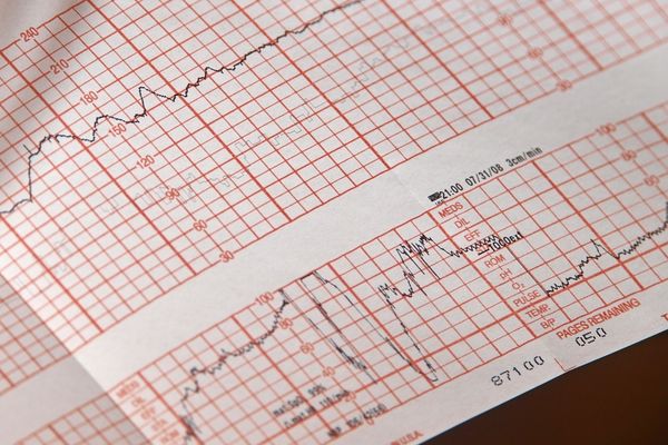 Ce este electrocardiograma (EKG)?