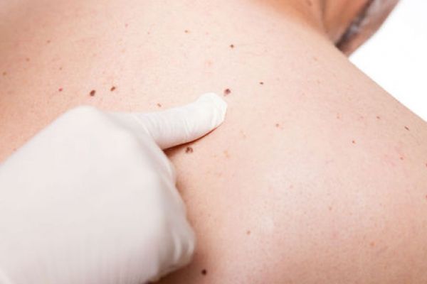 De ce apar alunițele și de ce este important să le identifici