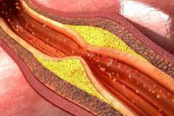 Ateroscleroza: cauze, simptome, măsuri de prevenție