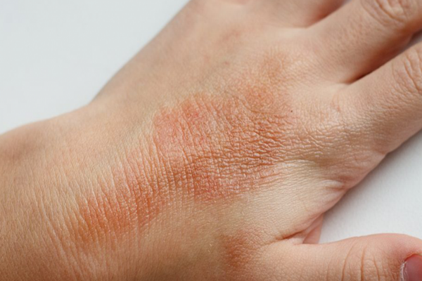 Eczema: Cauze, simptome, tratament