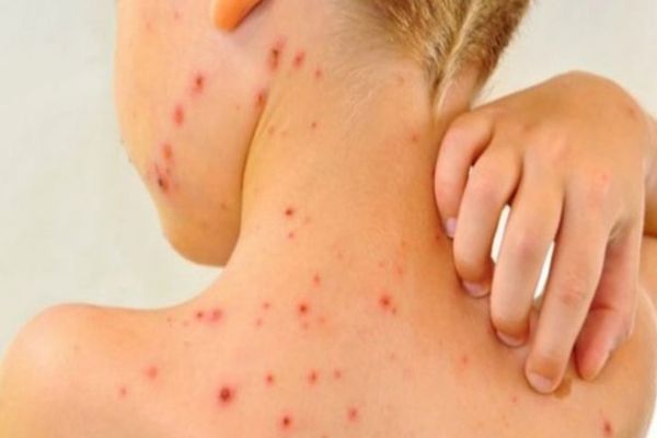 Rujeola lovește Europa. A crescut cu 30% numărul cazurilor înregistrate față de 2022