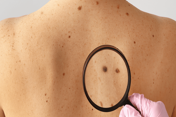 Regula cu ajutorul căreia poți identifica din timp cancerul de piele