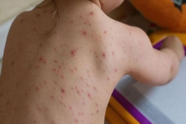 INSP: Peste 650 de cazuri noi de rujeolă înregistrate în ultima săptămână