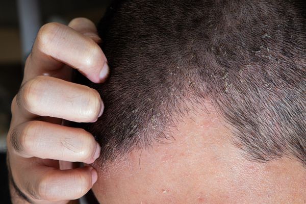 NUMĂRUL PACIENŢILOR CU DERMATITĂ ATOPICĂ - ÎN CREŞTERE, DIN CAUZA POLUĂRII ŞI A ALIMENTAŢIEI