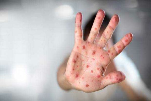 Rujeola revine la nivel global, avertizează OMS 