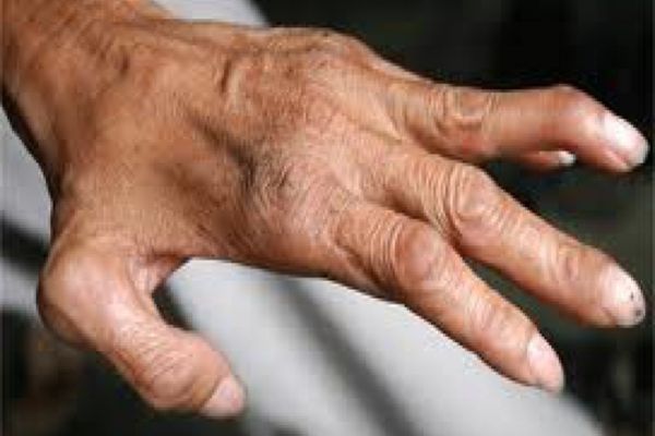 Un nou caz de lepră a fost confirmat la Cluj-Napoca. Sunt primele două cazuri înregistrate în România din 1981