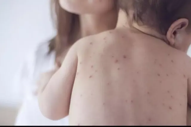 Rujeola lovește din nou România. Avertisment pentru cei care refuză vaccinarea: „Poate fi responsabil pentru sănătatea unui copil”