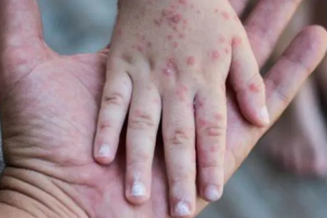 Risc uriaș de epidemie de rujeolă în România. Vaccinul ROR lipsește în mai multe județe