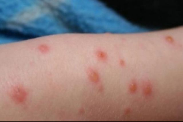 România, 85% din cazurile de rujeolă din Europa. Ministrul Sănătății: „Dezinformarea este la cote alarmante”