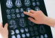 Premieră medicală la Londra: prima operație de creier asistată de inteligență artificială i-a salvat vederea unui bărbat