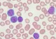 Transplant de celule stem pentru leucemia limfocitară cronică