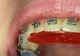 La ce vârstă trebuie purtat un aparat dentar mobil?