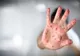 Aproape 800 de cazuri noi de rujeolă, în ultima săptămână, în România. Un copil de 10 ani, nevaccinat, a murit