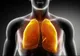 Pneumonia, o infecție ce nu trebuie ignorată