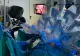 Tratamentul chirurgical al cancerului de prostată: Prostatectomia robotică