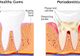 Parodontoza - cauze și simptome
